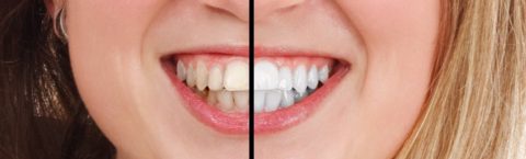 Teeth Whitening Dentists in Basingstoke