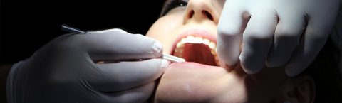 Dental Fillings