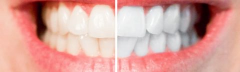 Basingstoke Teeth Whitening Dentist