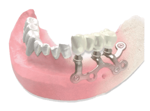 3D Implant Grid Solutions Sherborne St John