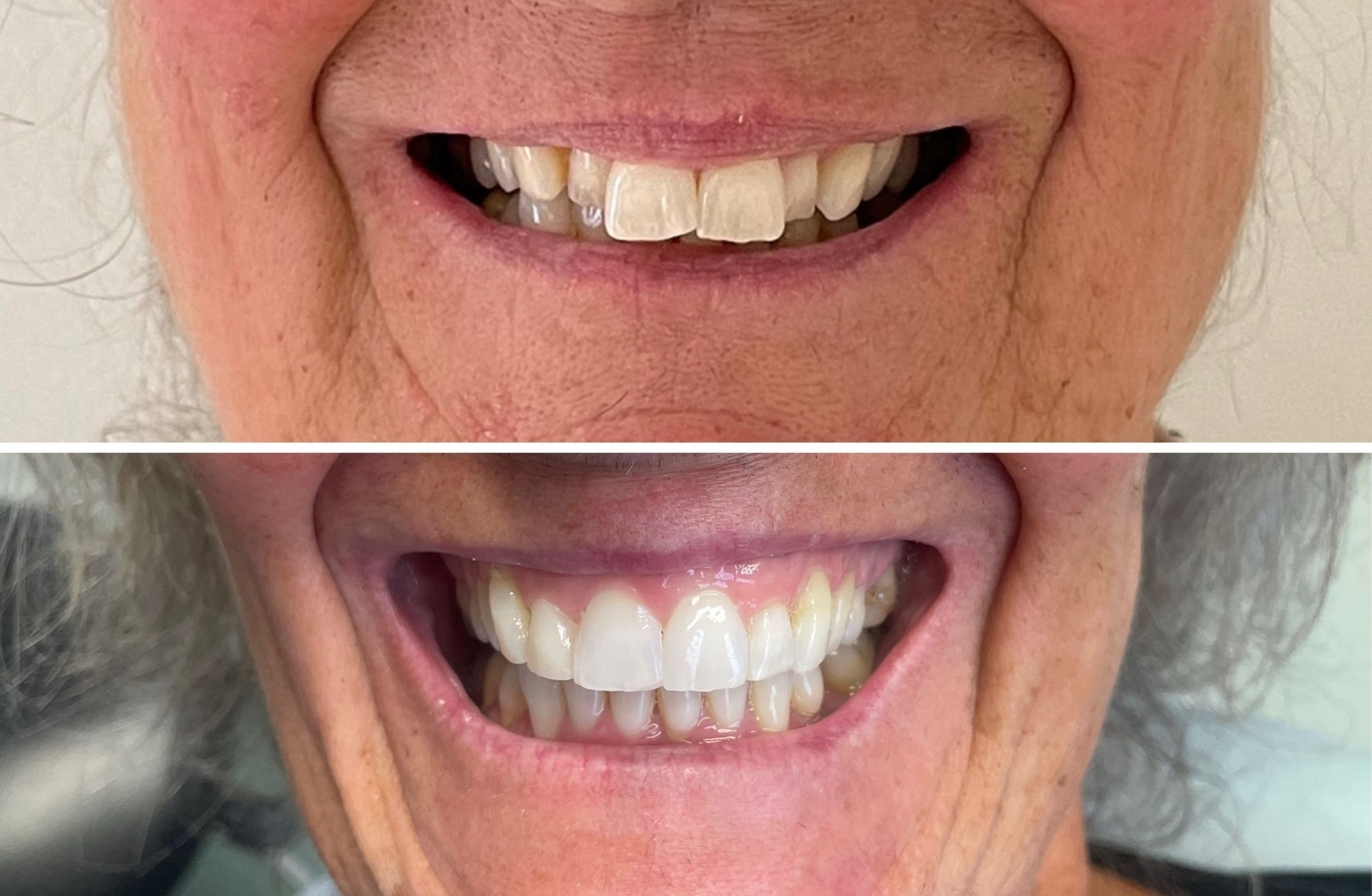 Clear Correct 3D Dental Implant Grid Solution Specialists Basingstoke